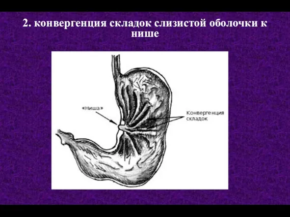 2. конвергенция складок слизистой оболочки к нише