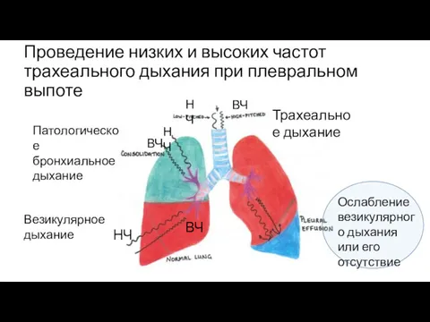 Проведение низких и высоких частот трахеального дыхания при плевральном выпоте