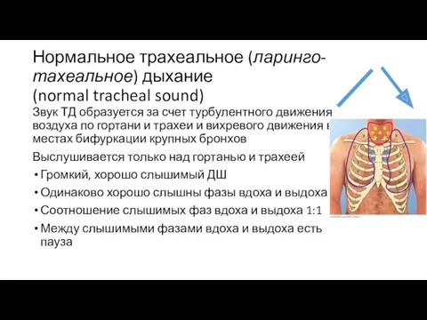 Нормальное трахеальное (ларинго-тахеальное) дыхание (normal tracheal sound) Звук ТД образуется