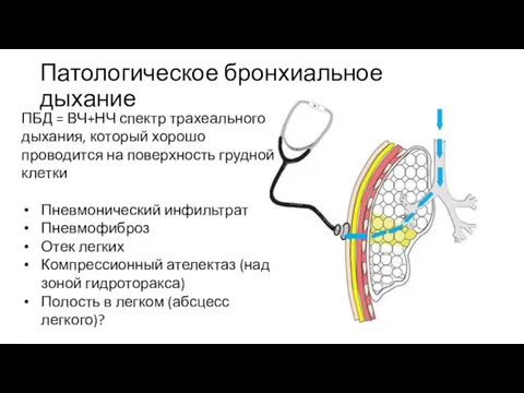 Патологическое бронхиальное дыхание ПБД = ВЧ+НЧ спектр трахеального дыхания, который