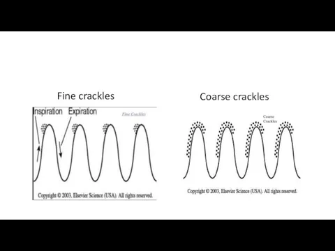 Fine crackles Coarse crackles