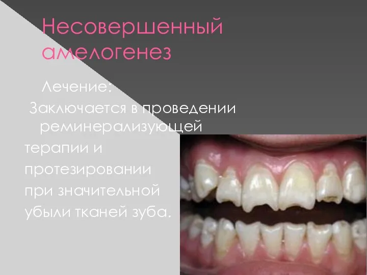 Несовершенный амелогенез Лечение: Заключается в проведении реминерализующей терапии и протезировании при значительной убыли тканей зуба.