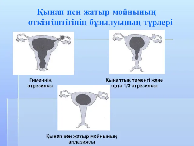 Қынап пен жатыр мойнының өткізгіштігінің бұзылуының түрлері Гименнің атрезиясы Қынап