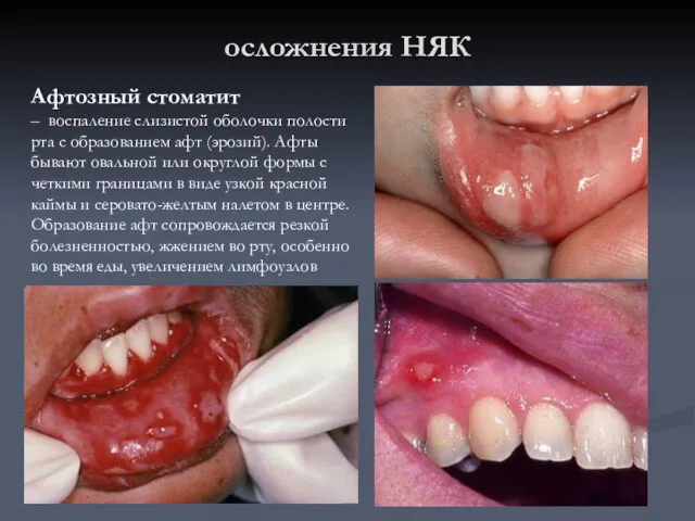 осложнения НЯК Афтозный стоматит – воспаление слизистой оболочки полости рта