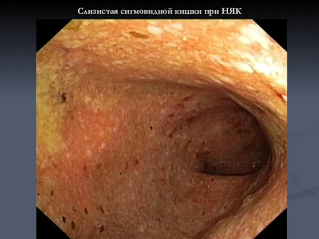 Слизистая сигмовидной кишки при НЯК