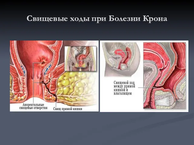 Свищевые ходы при Болезни Крона