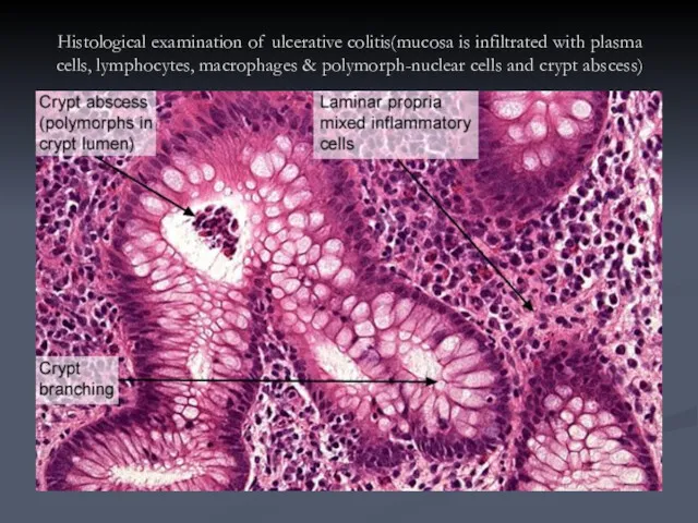 Histological examination of ulcerative colitis(mucosa is infiltrated with plasma cells,