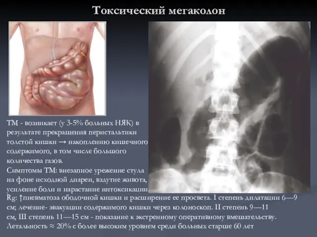 Токсический мегаколон Rg: ↑пневматоза ободочной кишки и расширение ее просвета.