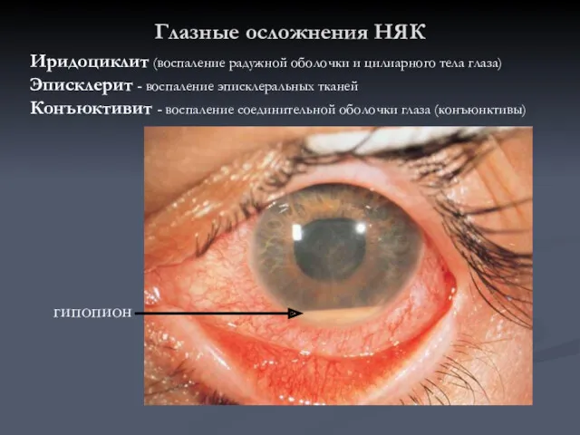 Глазные осложнения НЯК Иридоциклит (воспаление радужной оболочки и цилиарного тела