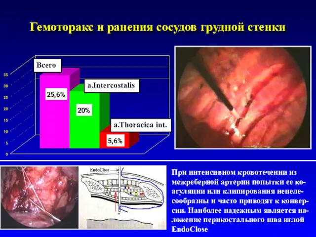 Гемоторакс и ранения сосудов грудной стенки Всего a.Intercostalis a.Thoracica int. При интенсивном кровотечении