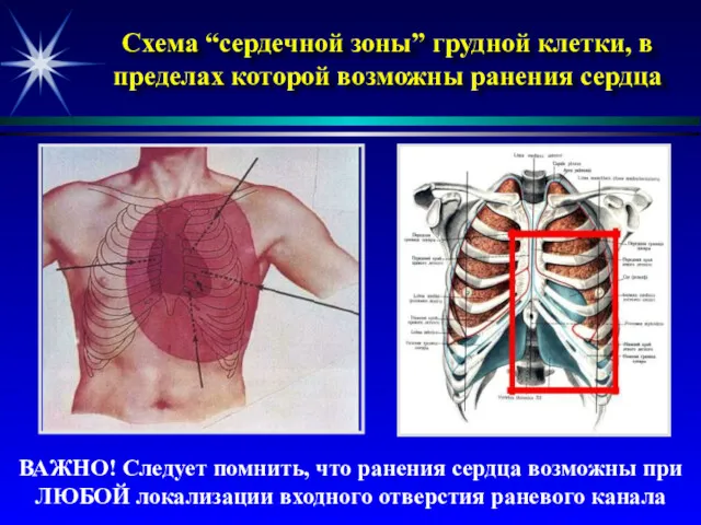 Схема “сердечной зоны” грудной клетки, в пределах которой возможны ранения