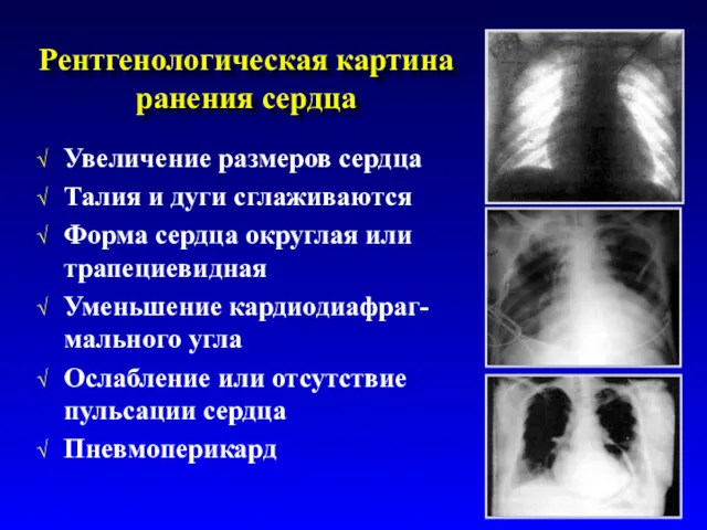 Рентгенологическая картина ранения сердца Увеличение размеров сердца Талия и дуги сглаживаются Форма сердца