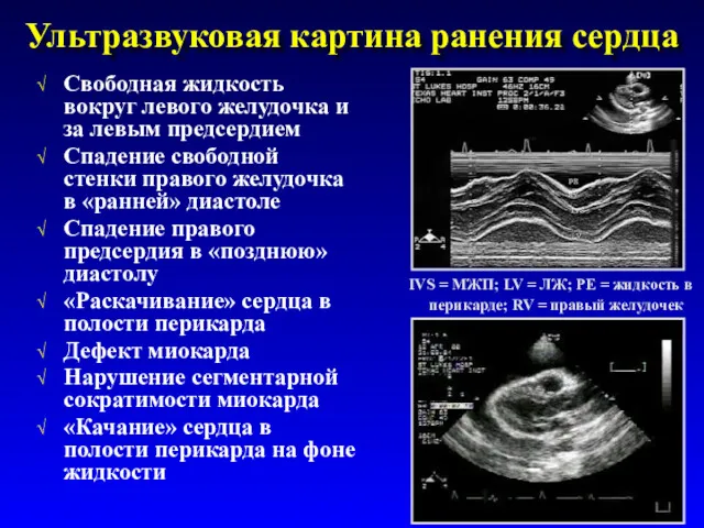 Ультразвуковая картина ранения сердца Свободная жидкость вокруг левого желудочка и за левым предсердием