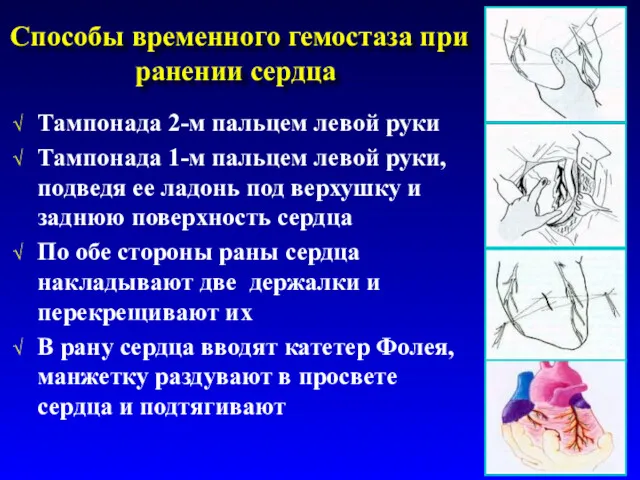 Способы временного гемостаза при ранении сердца Тампонада 2-м пальцем левой руки Тампонада 1-м