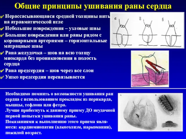 Общие принципы ушивания раны сердца Нерассасывающаяся средней толщины нить на атравматической игле Небольшие