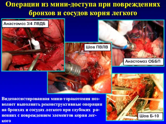 Операции из мини-доступа при повреждениях бронхов и сосудов корня легкого Видеоассистированная мини-торакотомия поз-