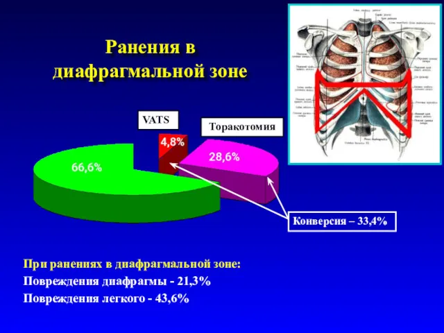 Ранения в диафрагмальной зоне Торакотомия VATS Конверсия – 33,4% При ранениях в диафрагмальной