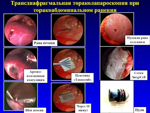 Трансдиафрагмальная тораколапароскопия при торакоабдоминальном ранении Рана печени Аргоно-плазменная коагуляция Шов