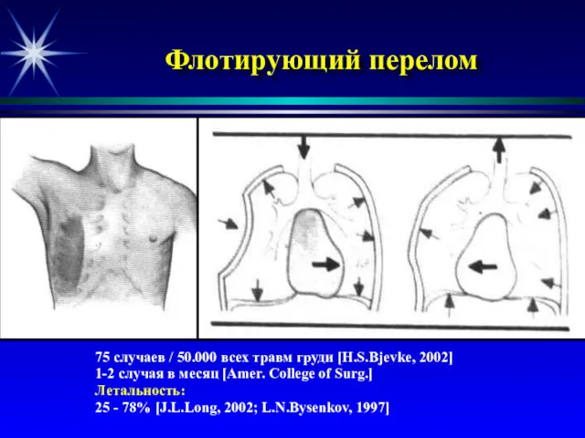 Флотирующий перелом 75 случаев / 50.000 всех травм груди [H.S.Bjevke, 2002] 1-2 случая