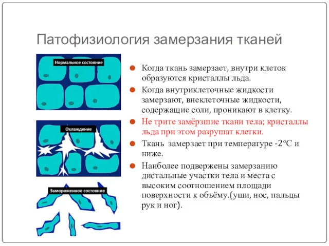 Патофизиология замерзания тканей Когда ткань замерзает, внутри клеток образуются кристаллы