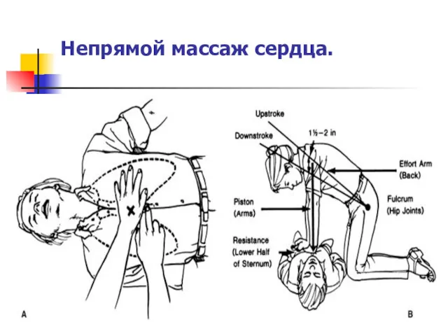 Непрямой массаж сердца.