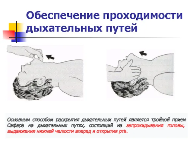 Обеспечение проходимости дыхательных путей Основным способом раскрытия дыхательных путей является