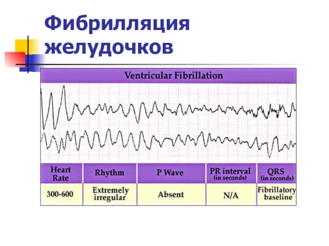 Фибрилляция желудочков