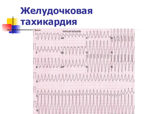 Желудочковая тахикардия