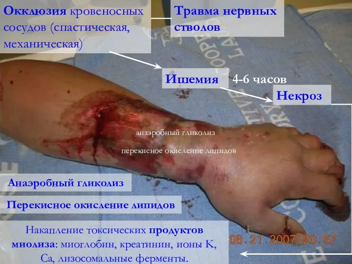Окклюзия кровеносных сосудов (спастическая, механическая) Ишемия Некроз 4-6 часов анаэробный
