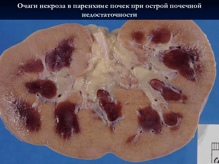 Очаги некроза в паренхиме почек при острой почечной недостаточности