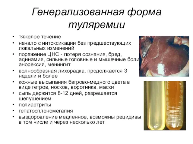 Генерализованная форма туляремии тяжелое течение начало с интоксикации без предшествующих