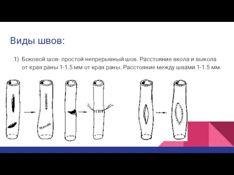 Виды швов: Боковой шов- простой непрерывный шов. Расстояние вкола и