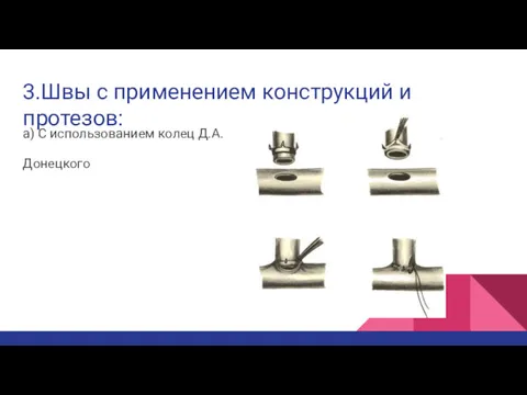 3.Швы с применением конструкций и протезов: а) С использованием колец Д.А. Донецкого