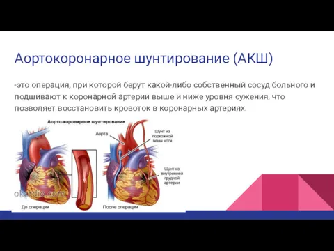 Аортокоронарное шунтирование (АКШ) -это операция, при которой берут какой-либо собственный