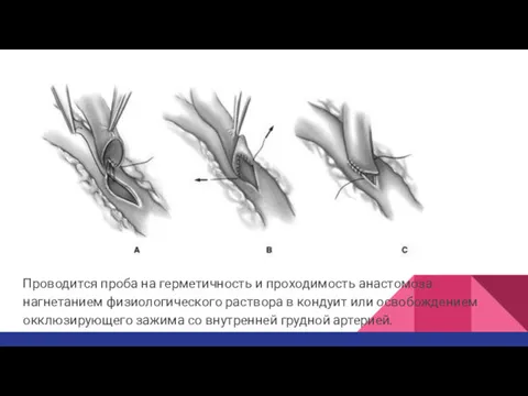 Проводится проба на герметичность и проходимость анастомоза нагнетанием физиологического раствора