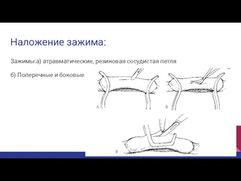 Наложение зажима: Зажимы:а) атравматические, резиновая сосудистая петля б) Поперечные и боковые