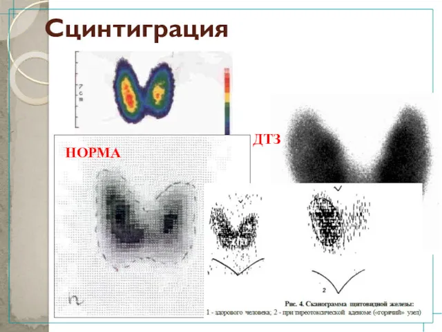 Сцинтиграция НОРМА ДТЗ