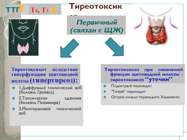 Тиреотоксикоз 1.Диффузный токсический зоб (болезнь Грейвса) 2.Токсическая аденома (болезнь Плюммера) 3.Многоузловой токсический зоб