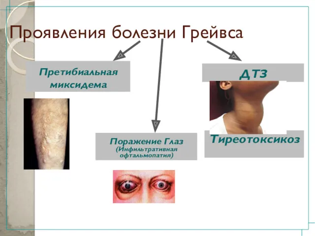 Проявления болезни Грейвса ДТЗ Поражение Глаз (Инфильтративная офтальмопатия) Претибиальная миксидема Тиреотоксикоз