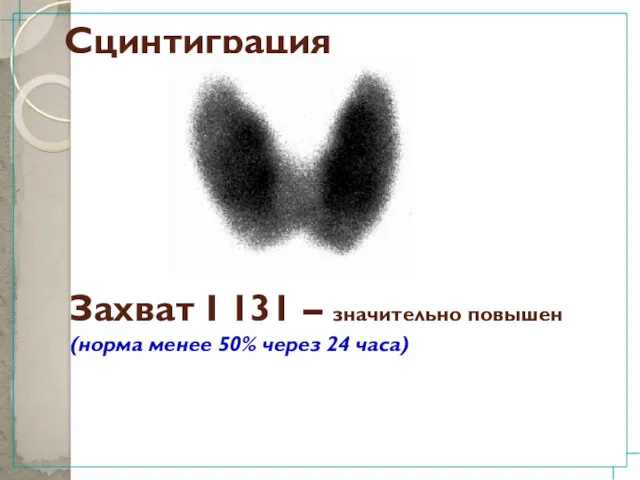 Сцинтиграция Захват I 131 – значительно повышен (норма менее 50% через 24 часа)