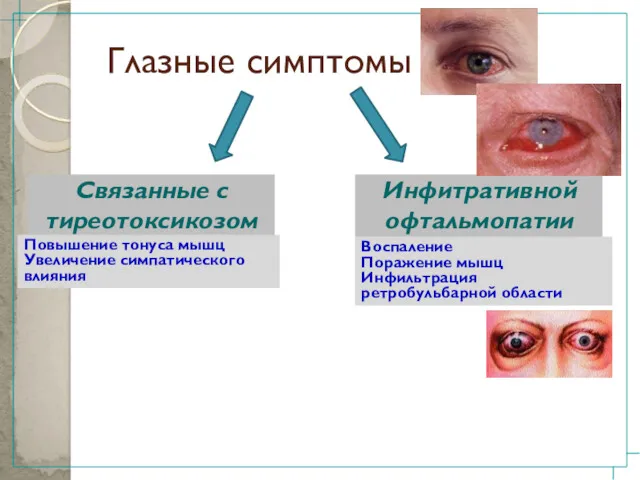 Глазные симптомы Связанные с тиреотоксикозом Инфитративной офтальмопатии Повышение тонуса мышц Увеличение симпатического влияния