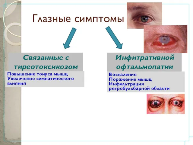 Глазные симптомы Связанные с тиреотоксикозом Инфитративной офтальмопатии Повышение тонуса мышц
