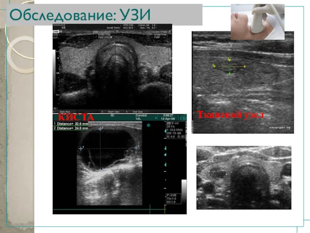 Обследование: УЗИ КИСТА Тканевой узел