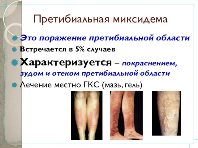 Претибиальная миксидема Это поражение претибиальной области Встречается в 5% случаев