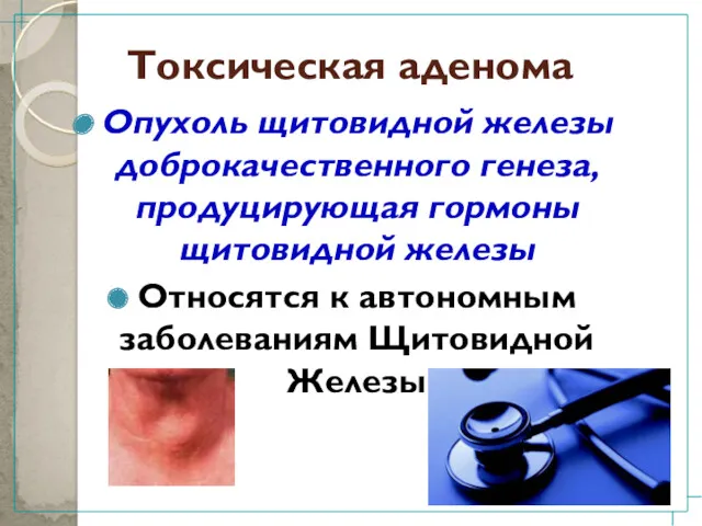 Токсическая аденома Опухоль щитовидной железы доброкачественного генеза, продуцирующая гормоны щитовидной