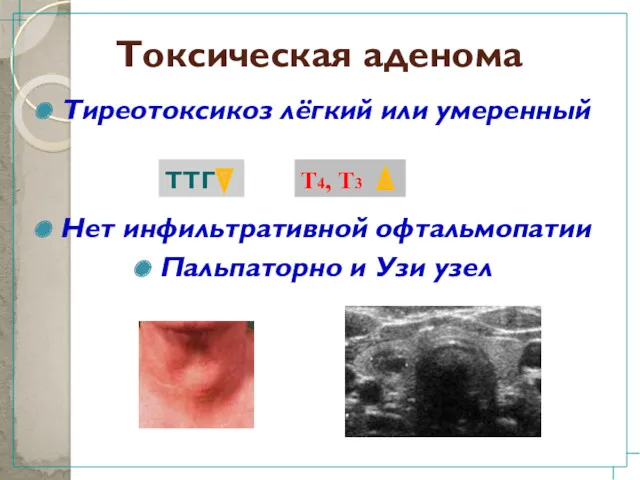 Токсическая аденома Тиреотоксикоз лёгкий или умеренный Нет инфильтративной офтальмопатии Пальпаторно и Узи узел ТТГ Т4, Т3