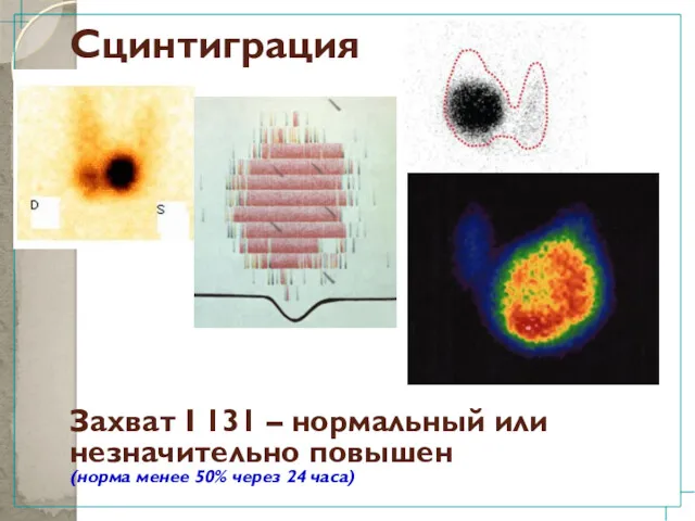 Сцинтиграция Захват I 131 – нормальный или незначительно повышен (норма менее 50% через 24 часа)