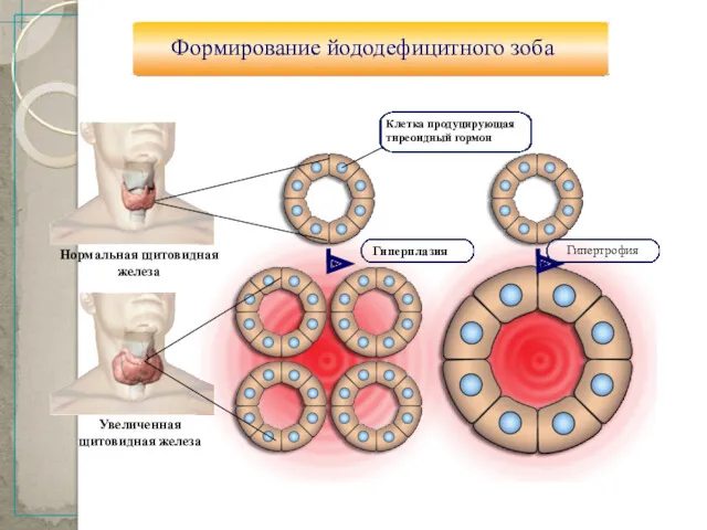 17 Формирование йододефицитного зоба Нормальная щитовидная железа Увеличенная щитовидная железа Гиперплазия Гипертрофия Клетка продуцирующая тиреоидный гормон