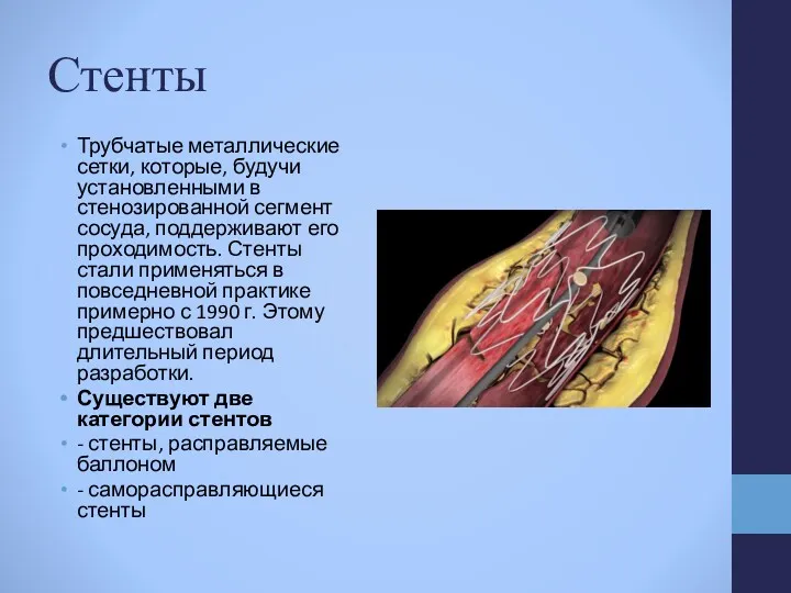 Стенты Трубчатые металлические сетки, которые, будучи установленными в стенозированной сегмент