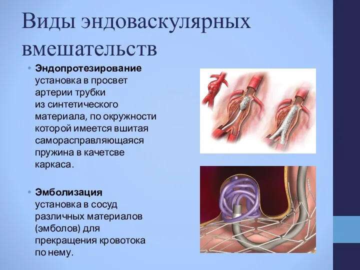 Виды эндоваскулярных вмешательств Эндопротезирование установка в просвет артерии трубки из